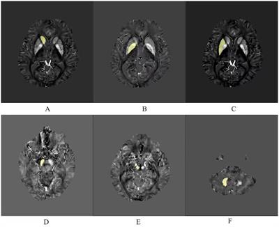 Correlation between iron deposition and cognitive function in mild to moderate Alzheimer’s disease based on quantitative susceptibility mapping